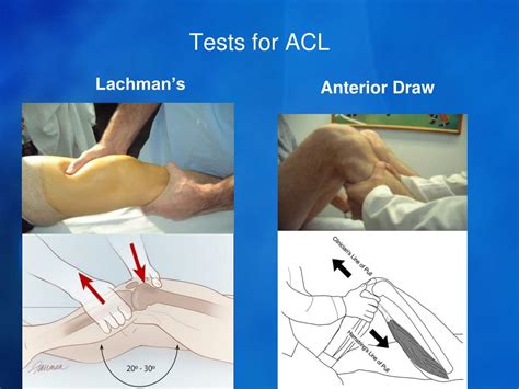 acl tear and shelf test|lachman test positive sign.